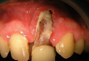 Osteomielite in base al fuoco dei denti